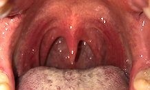 Pharyngitis